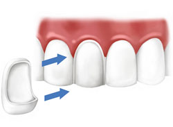 Эстетическое восстановление зубов винирами