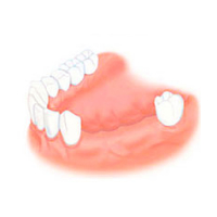 Полное отсутствие  зубов верхней/нижней  челюсти