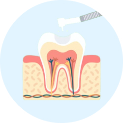 Обезболивание Удаление пораженных кариесом твёрдых тканей зуба