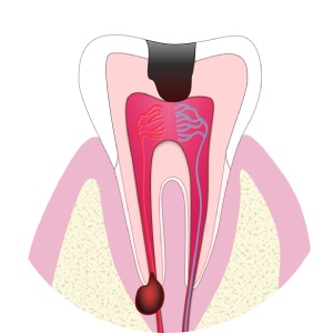 ToothwithCaries (1) (1)