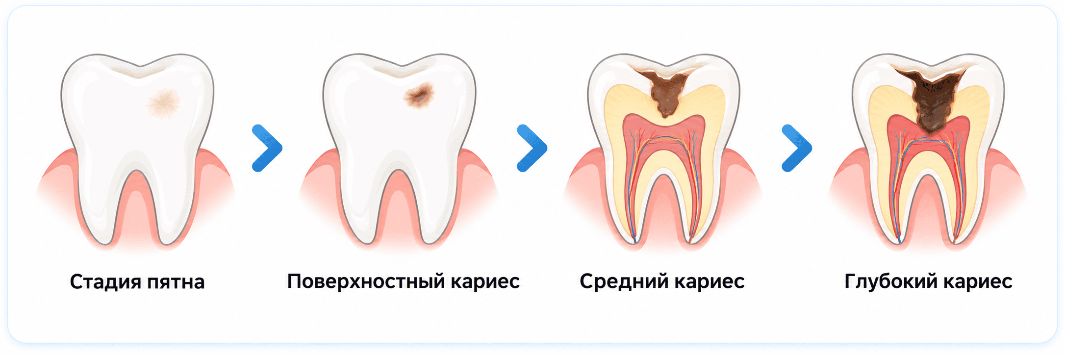 Стадии кариеса